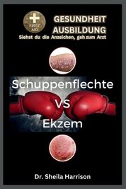 Schuppenflechte Psoriasis Versus Ekzem Unterschiede Hnlichkeiten