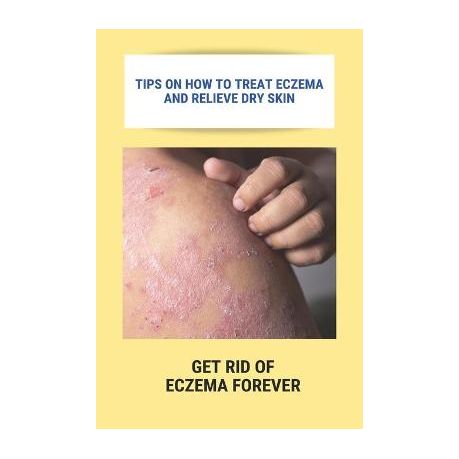 Tips On How To Treat Eczema And Relieve Dry Skin: Get Rid Of Eczema Forever: Overcome Eczema Image