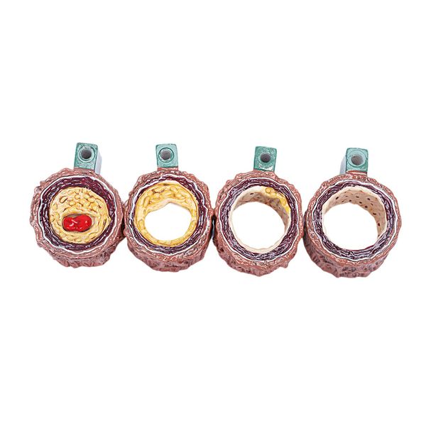 Atherosclerosis Thrombosis Model Vascular Disease Compatible with None