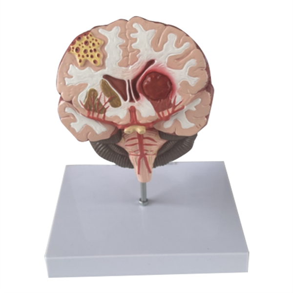Human Brain Disease Model-Brainstem Hemorrhage Medical Compatible with None