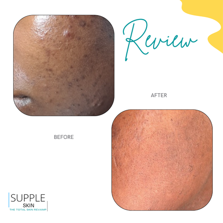 Kojic Acid Serum For Dark spots And Brightening With Glutathione | Shop  Today. Get it Tomorrow!
