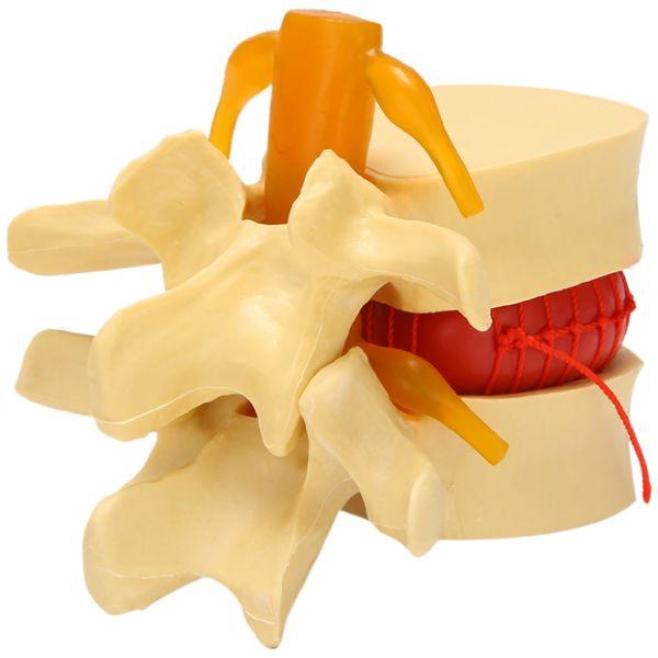 Lumbar Vertebrae Model Lumbar Disc Herniation Anatomy Teaching Tool