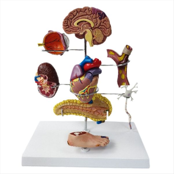 Type II Diabetes Model Set for Human Anatomy