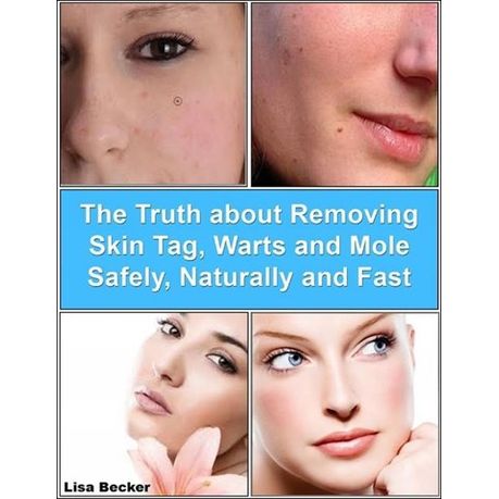 Naturally remove and to moles how freckles How to